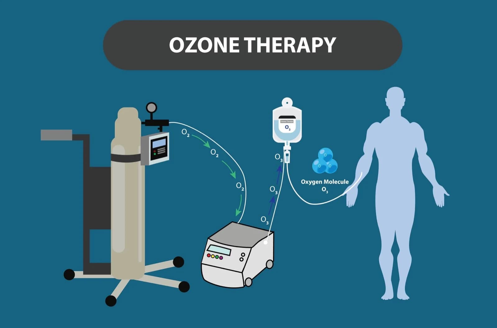 Ozon Terapi